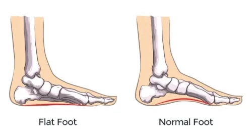 insoles for flat feet